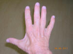 Muscle Atrophy and Weakness in Hand and Fingers Due to Pinched Ulnar Nerve